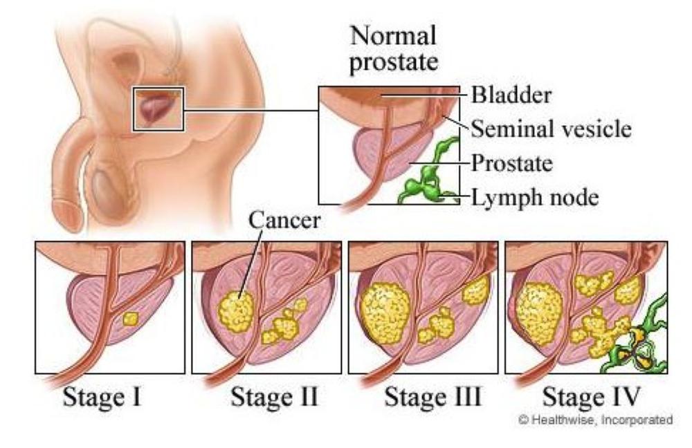 Vitamin E may increase risk of prostate&nbsp;cancer