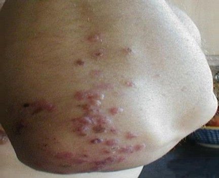 Mysterious raised bumps on elbows rash outbreak is causing&nbsp;alarm